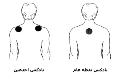 نقاط بادکش گذاری