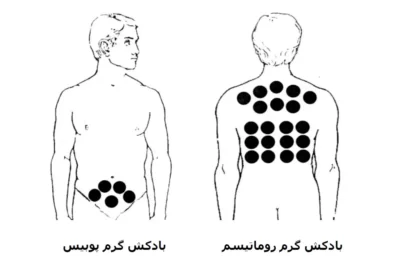 نقاط بادکش گذاری