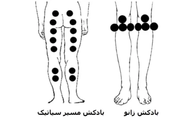 نقاط بادکش گذاری