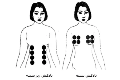 نقاط بادکش گذاری