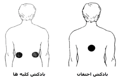 نقاط بادکش گذاری