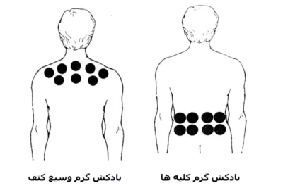 نقاط بادکش گذاری