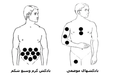 نقاط بادکش گذاری