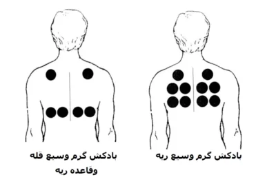 نقاط بادکش گذاری