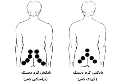 نقاط بادکش گذاری