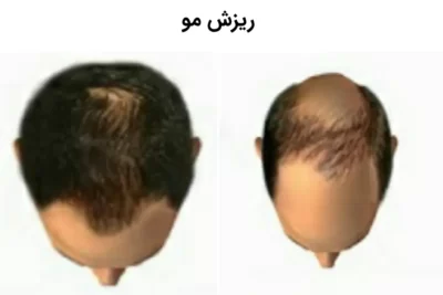 ریزش مو