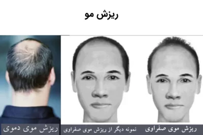 ریزش مو